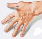 Autoimmune Diseases diagnosing rheumatoid arthritis RA hand swan picture