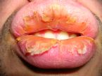 Exfoliative Cheilitis Pictures ... (Click to enlarge)