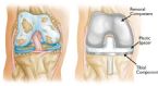 Knee Replacement Surgery Image ... (Click to enlarge)