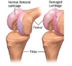 autoimmune Disease how Rheumatoid arthritis signs ... (Click to enlarge)