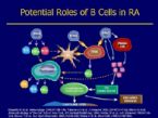 autoimmune diseasesx Rheumatoid arthritis synovial joint is infiltrate