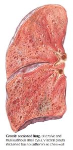 rheumatoid arthritis disease in the lung chest visceral pleural thickn