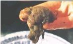 Mucoid Plaque. Photo from Dr. Jensen's  Bowel Management Book