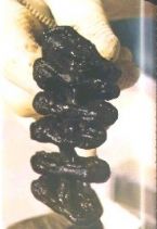 Mucoid Plaque. Photo from Dr. Bernard Jensen's  Bowel Management Book