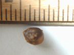 Kidney Stone 205 30 05