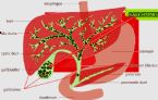 Gallstones