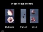 Liver Flush Results