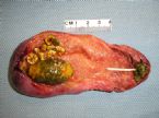 Cholesterol Gallstone in situ