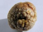 1.5 cm gallstone