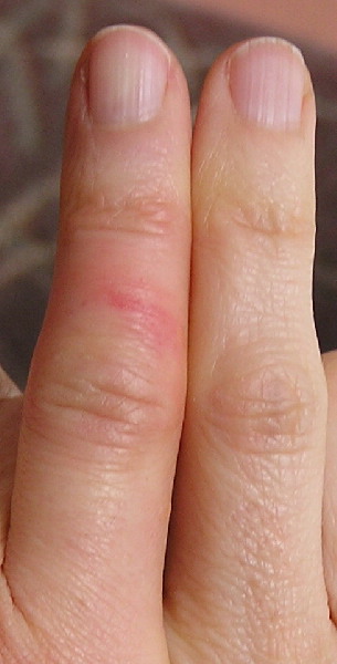 swollen-finger-another-strange-lf-symptom-at-liver-flush-support