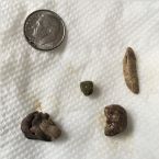 Mixed Gallstones