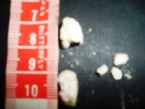 white stones from my first liver flush ... (Click to enlarge)