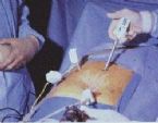 gallbladder surgery