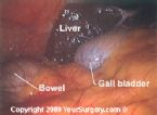 gallbladder surgery