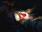 gallbladder surgery