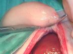 gallbladder surgery