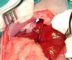 gallbladder surgery