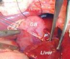 gallbladder surgery