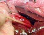 gallbladder surgery