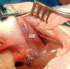 gallbladder surgery