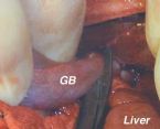 gallbladder surgery