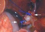 gallbladder surgery