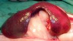 gallbladder surgery