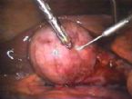 gallbladder surgery