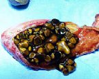 gallstones from the gallbladder