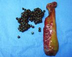 gallstones from the gallbladder