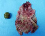 gallstones from the gallbladder