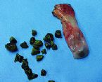 gallstones from the gallbladder