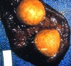 gallstones from the gallbladder