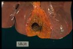 intrahepatic stones