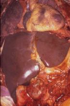 intrahepatic stones