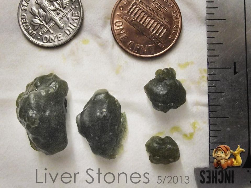 //www.curezone.org/upload/Members/Faces/New/Liver_Stones_5871_01_May26_2013_Elf_Hardtoil.jpg