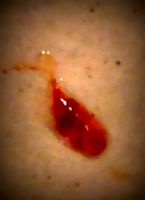 Parasite_I_Found in nasal cavity cyst