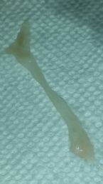 Worm (?) From throat