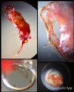 Skin Parasite Morgellons Disease Photos Tentacles Skin Damage