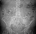 CT Scan Guts