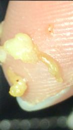 weird stuff in between teeth