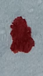 Blood smear showing parasitic infection