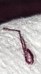 Dead hookworm from scalp