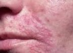 candida infection fungus skin