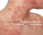 eczma skin condition candida rash