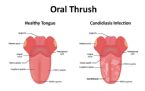 oral thrush candida albicans mouth