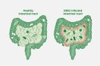 sibo infection intestinal track