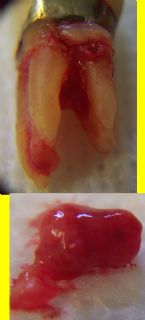 Tooth Abscess