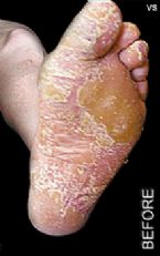 Psoriasis