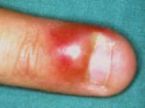 infected finger ... (Click to enlarge)